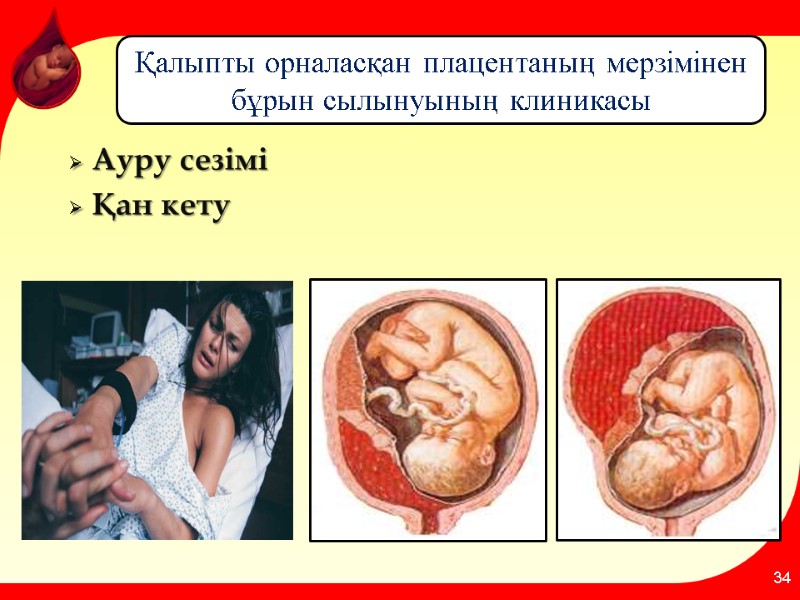 Ауру сезімі Қан кету 34 Қалыпты орналасқан плацентаның мерзімінен бұрын сылынуының клиникасы